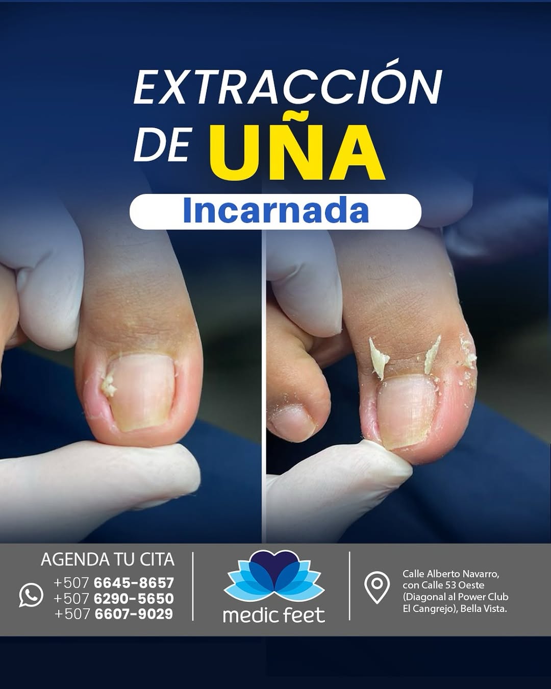 Tratamiento de Uñas Incarnadas